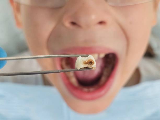 Best Emergency Wisdom Teeth Removal in Vincent, CA