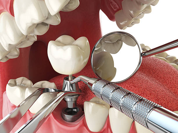 Best Emergency Dental Care for Broken or Chipped Teeth in Vincent, CA